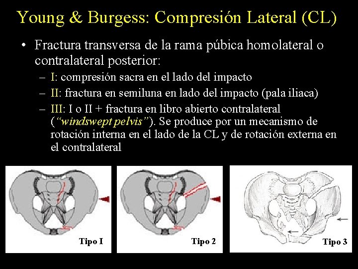 Young & Burgess: Compresión Lateral (CL) • Fractura transversa de la rama púbica homolateral