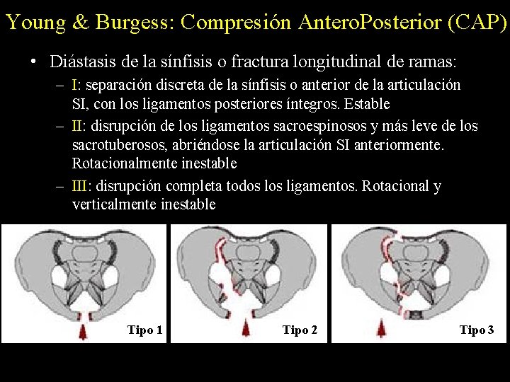 Young & Burgess: Compresión Antero. Posterior (CAP) • Diástasis de la sínfisis o fractura