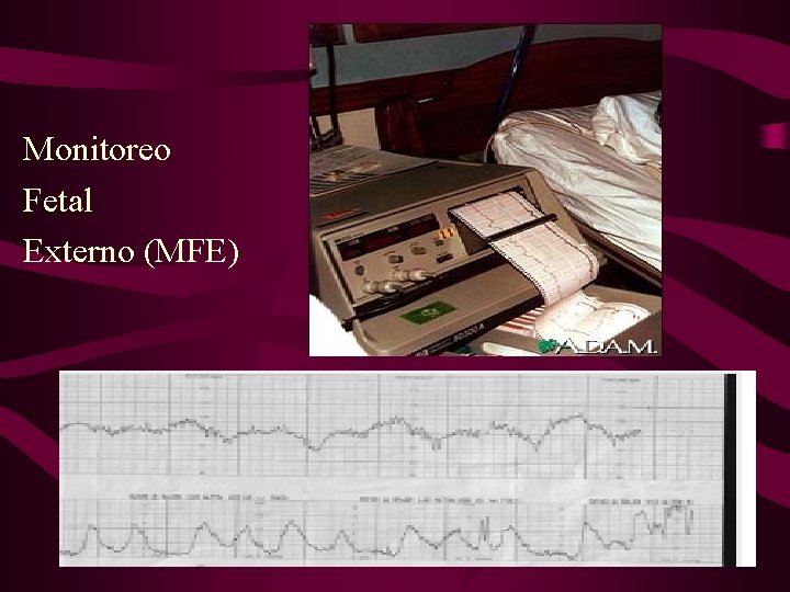 Monitoreo Fetal Externo (MFE) 