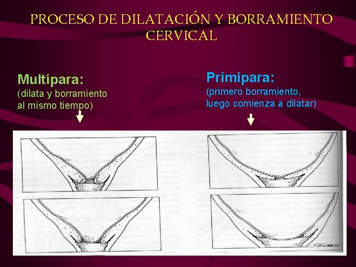 PROCESO DE DILATACIÓN Y BORRAMIENTO CERVICAL Multípara: (dilata y borramiento al mismo tiempo) Primípara: