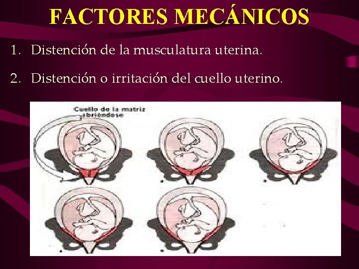 FACTORES MECÁNICOS 1. Distención de la musculatura uterina. 2. Distención o irritación del cuello FACTORES MECÁNICOS 1. Distención de la musculatura uterina. 2. Distención o irritación del cuello