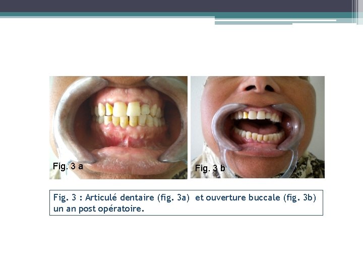 Fig. 3 a Fig. 3 b Fig. 3 : Articulé dentaire (fig. 3 a)