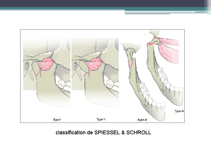 classification de SPIESSEL & SCHROLL 