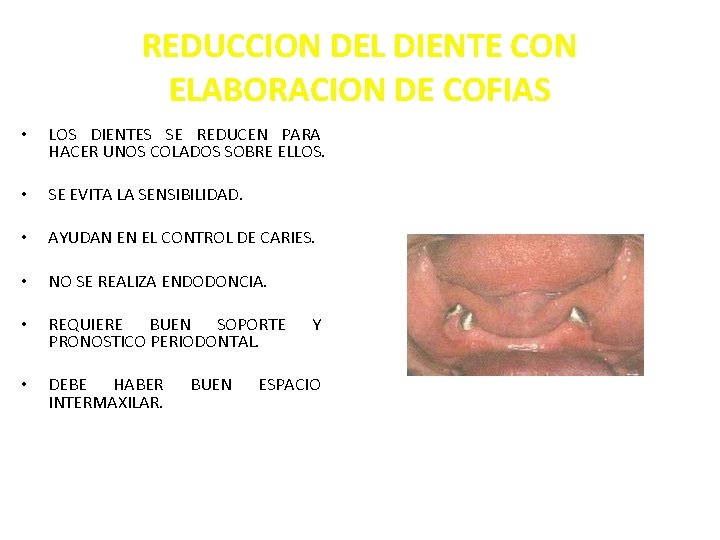 REDUCCION DEL DIENTE CON ELABORACION DE COFIAS • LOS DIENTES SE REDUCEN PARA HACER