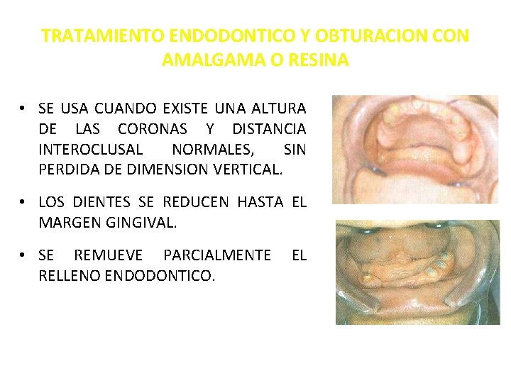 TRATAMIENTO ENDODONTICO Y OBTURACION CON AMALGAMA O RESINA • SE USA CUANDO EXISTE UNA