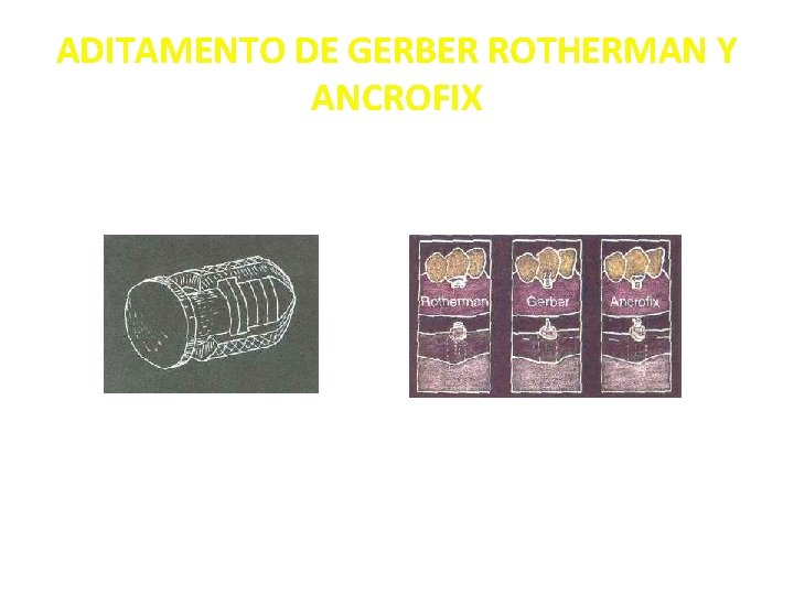 ADITAMENTO DE GERBER ROTHERMAN Y ANCROFIX 