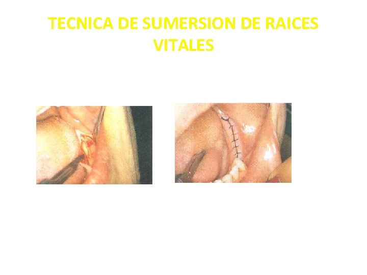 TECNICA DE SUMERSION DE RAICES VITALES 