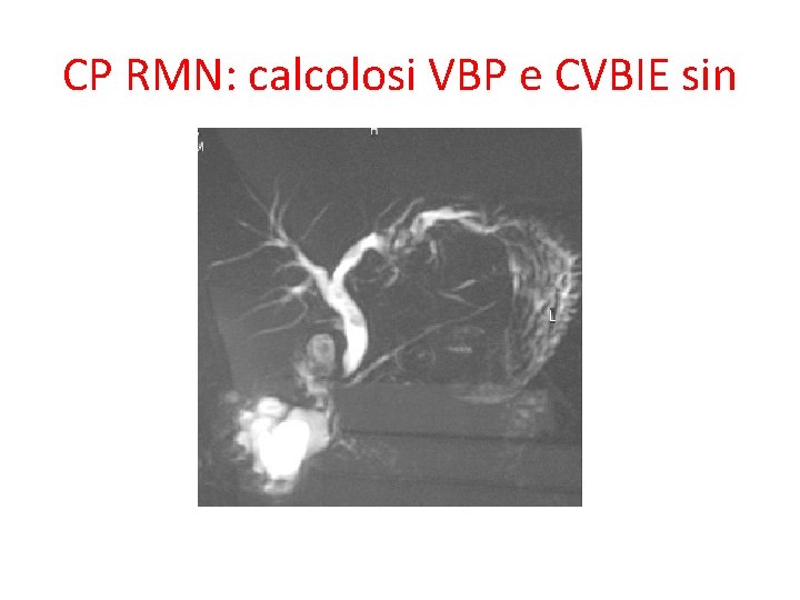 CP RMN: calcolosi VBP e CVBIE sin 