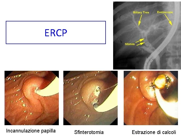 ERCP Incannulazione papilla Sfinterotomia Estrazione di calcoli 