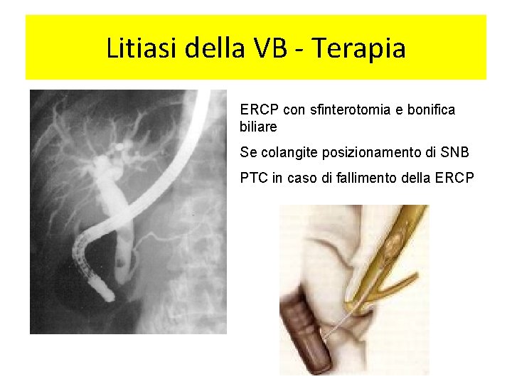 Litiasi della VB - Terapia ERCP con sfinterotomia e bonifica biliare Se colangite posizionamento