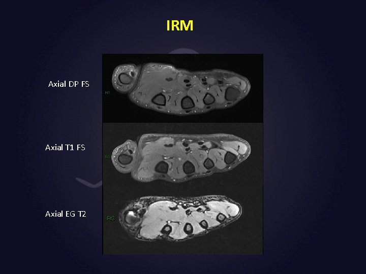 IRM Axial DP FS Axial T 1 FS Axial EG T 2 