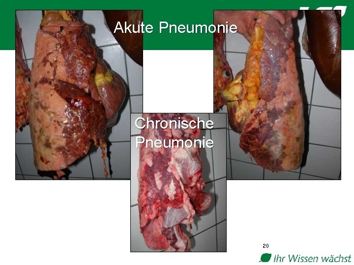 Akute Pneumonie Chronische Pneumonie 20 