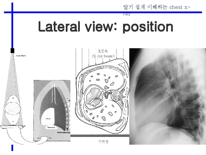 알기 쉽게 이해하는 chest xray Lateral view: position 