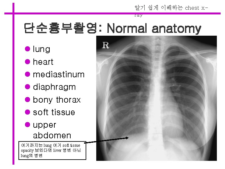 알기 쉽게 이해하는 chest xray 단순흉부촬영: Normal anatomy l lung l heart l mediastinum