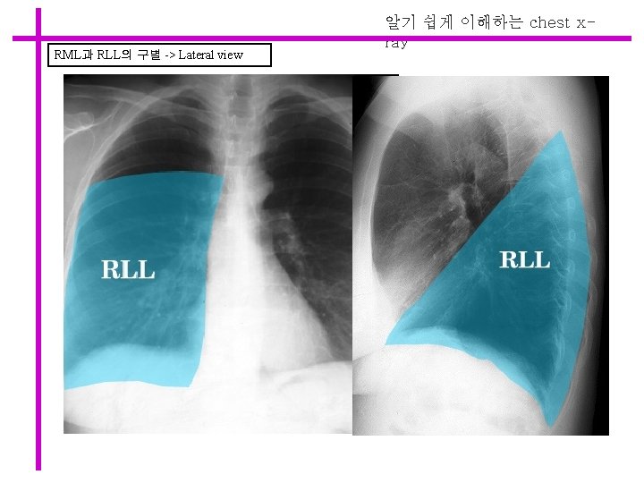 RML과 RLL의 구별 -> Lateral view 알기 쉽게 이해하는 chest xray 