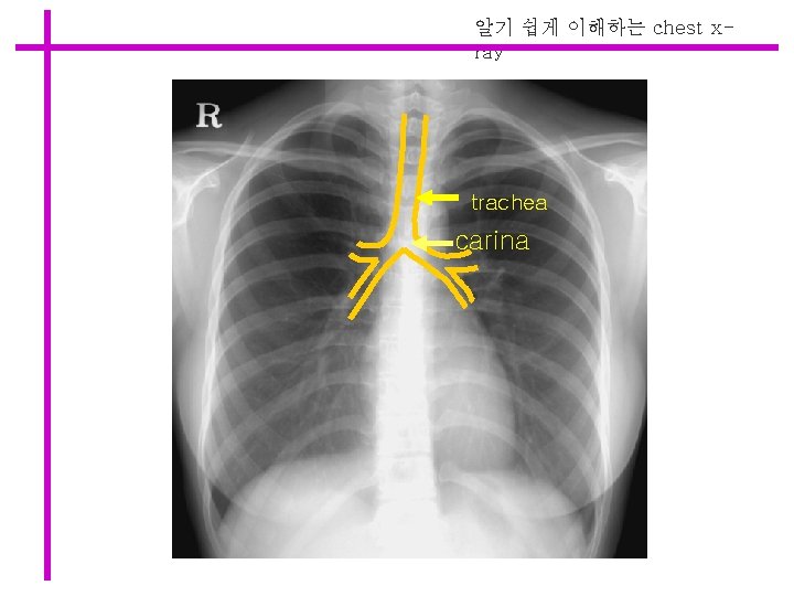 알기 쉽게 이해하는 chest xray trachea carina 