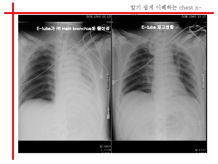 알기 쉽게 이해하는 chest xray E-tube가 Rt main bronchus에 들어감 E-tube 재고정함 