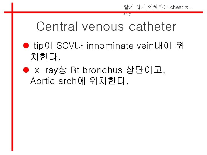 알기 쉽게 이해하는 chest xray Central venous catheter l tip이 SCV나 innominate vein내에 위