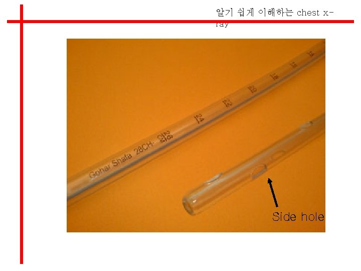 알기 쉽게 이해하는 chest xray Side hole 