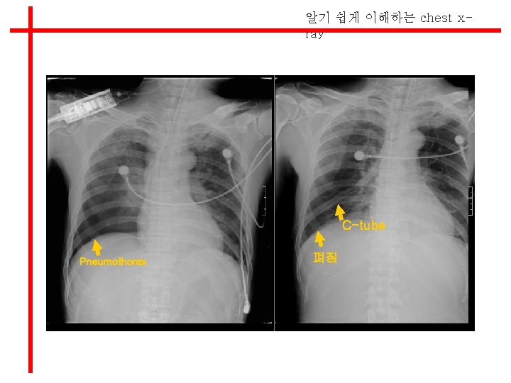 알기 쉽게 이해하는 chest xray C-tube Pneumothorax 펴짐 