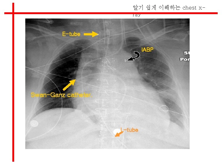 알기 쉽게 이해하는 chest xray E-tube IABP Swan-Ganz catheter. L-tube 