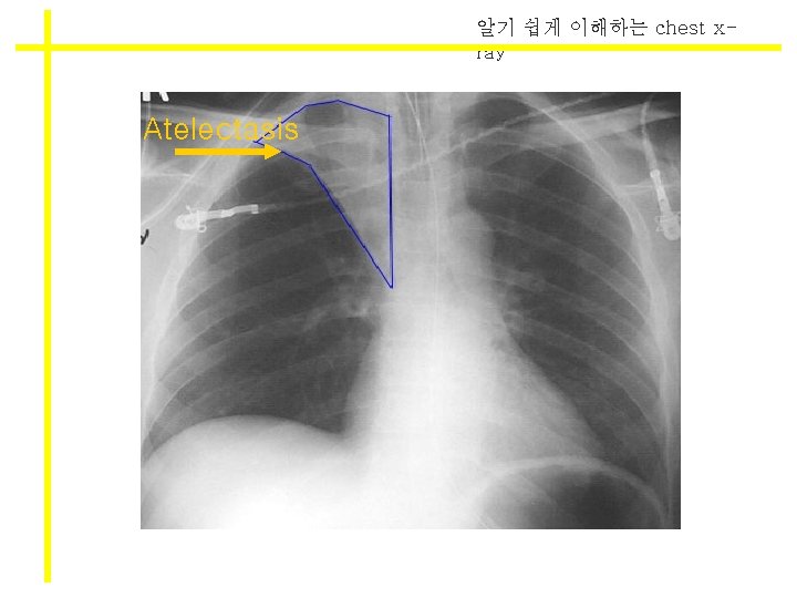 알기 쉽게 이해하는 chest xray Atelectasis 