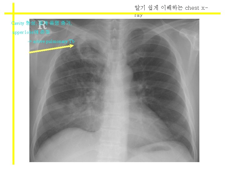 알기 쉽게 이해하는 chest xray Cavity 형성, 경계 음영 증가, upper lobe에 존재 ->