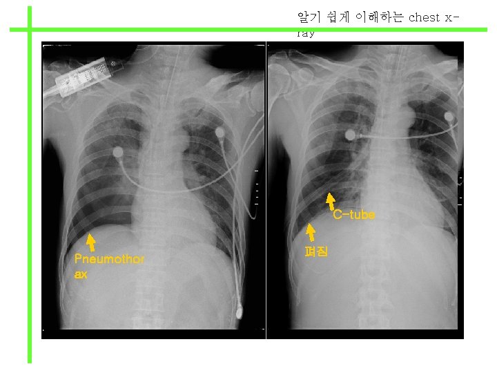 알기 쉽게 이해하는 chest xray C-tube Pneumothor ax 펴짐 