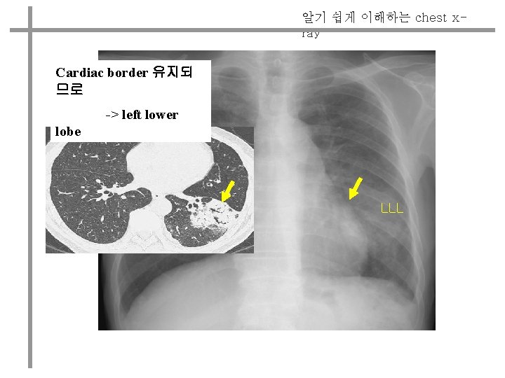 알기 쉽게 이해하는 chest xray Cardiac border 유지되 므로 -> left lower lobe LLL