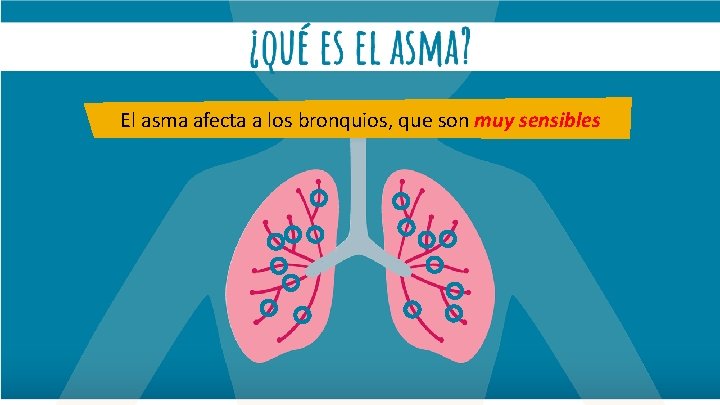 El asma afecta a los bronquios, que son muy sensibles 