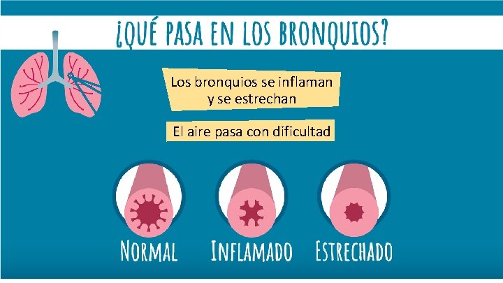 Los bronquios se inflaman y se estrechan El aire pasa con dificultad 