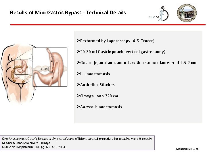 Results of Mini Gastric Bypass - Technical Details ØPerformed by Laparoscopy (4 -5 Trocar)