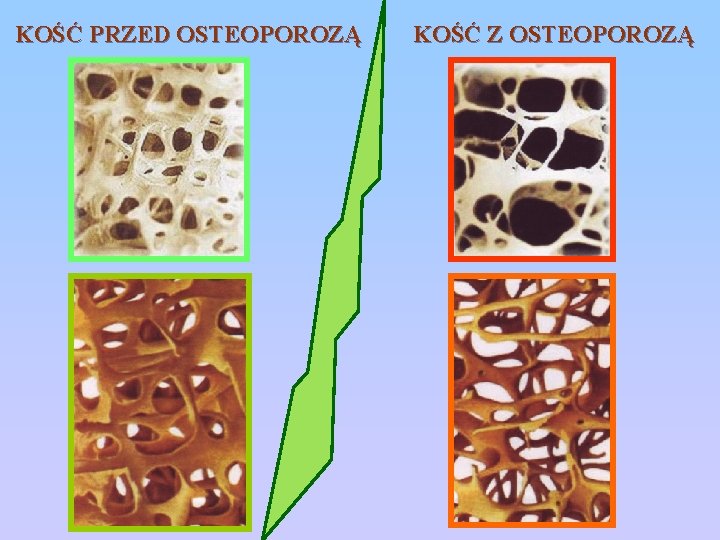 KOŚĆ PRZED OSTEOPOROZĄ KOŚĆ Z OSTEOPOROZĄ 