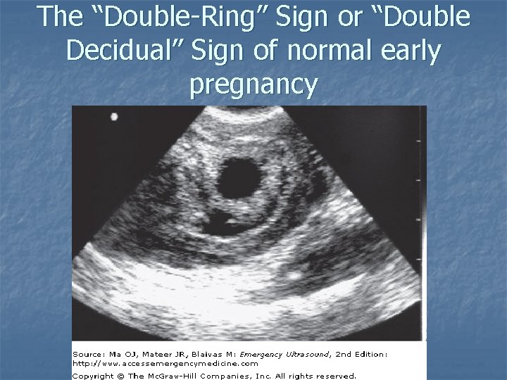 The “Double-Ring” Sign or “Double Decidual” Sign of normal early pregnancy 