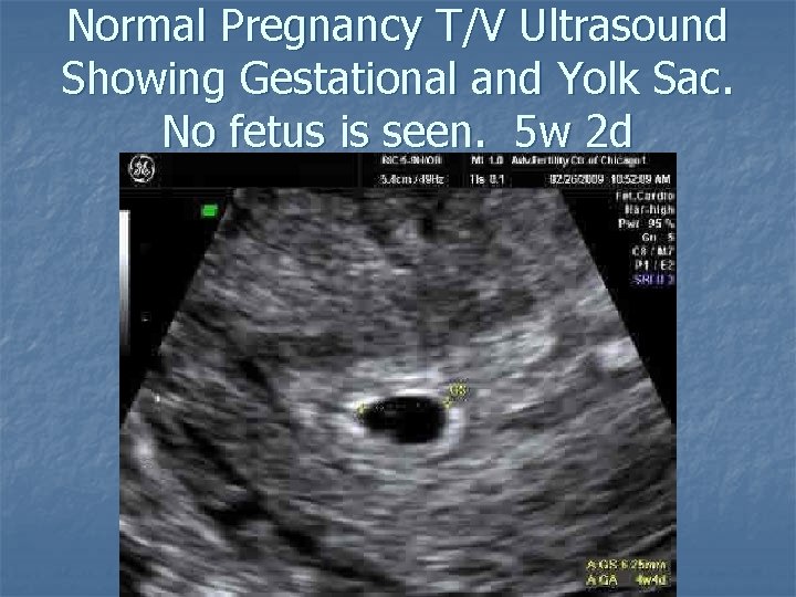 Normal Pregnancy T/V Ultrasound Showing Gestational and Yolk Sac. No fetus is seen. 5