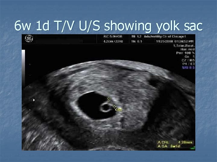 6 w 1 d T/V U/S showing yolk sac 