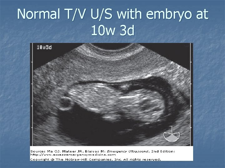 Normal T/V U/S with embryo at 10 w 3 d 