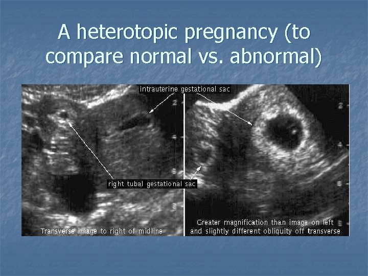 A heterotopic pregnancy (to compare normal vs. abnormal) 