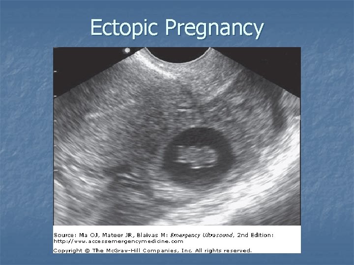 Ectopic Pregnancy 