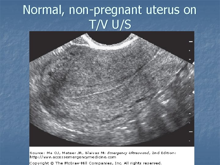 Normal, non-pregnant uterus on T/V U/S 