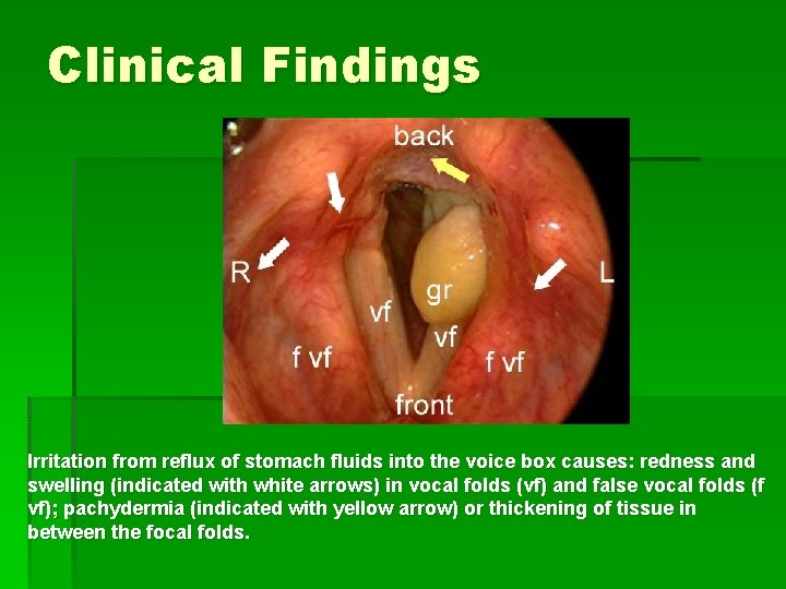 Clinical Findings Irritation from reflux of stomach fluids into the voice box causes: redness