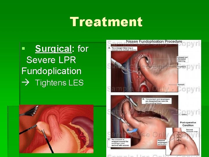 Treatment § Surgical: for Severe LPR Fundoplication Tightens LES 