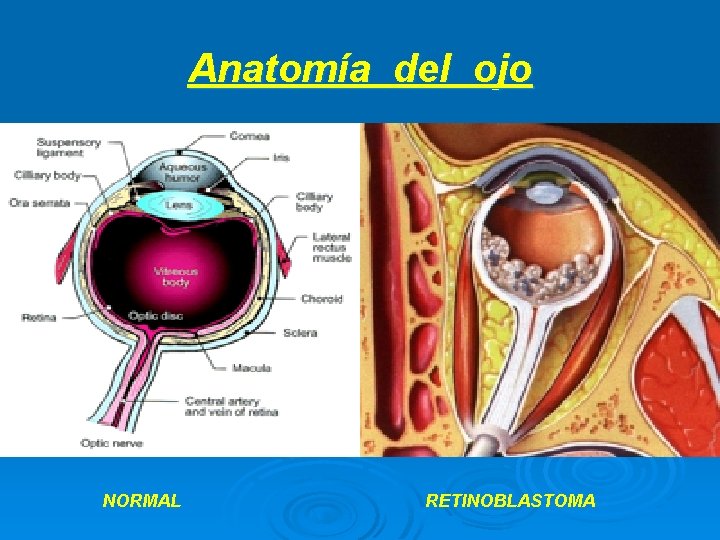 Anatomía del ojo NORMAL RETINOBLASTOMA 