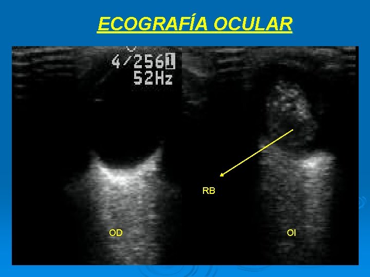 ECOGRAFÍA OCULAR RB OD OI 