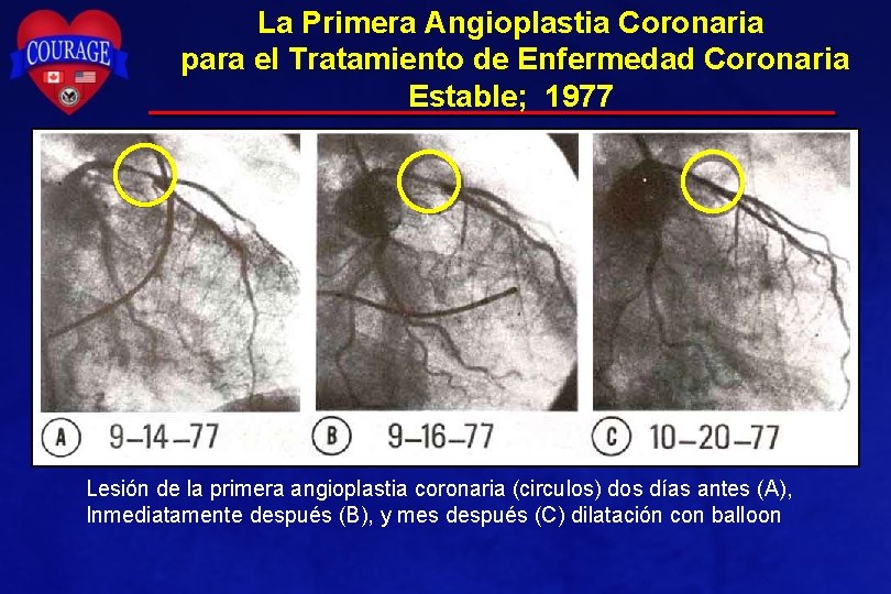 La Primera Angioplastia Coronaria para el Tratamiento de Enfermedad Coronaria Estable; 1977 Lesión de