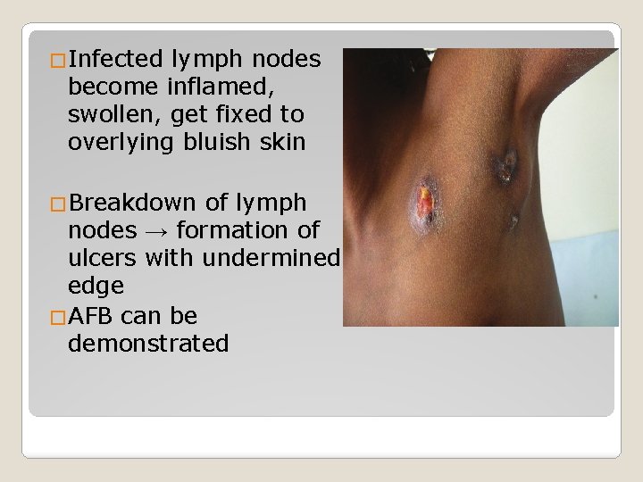�Infected lymph nodes become inflamed, swollen, get fixed to overlying bluish skin �Breakdown of