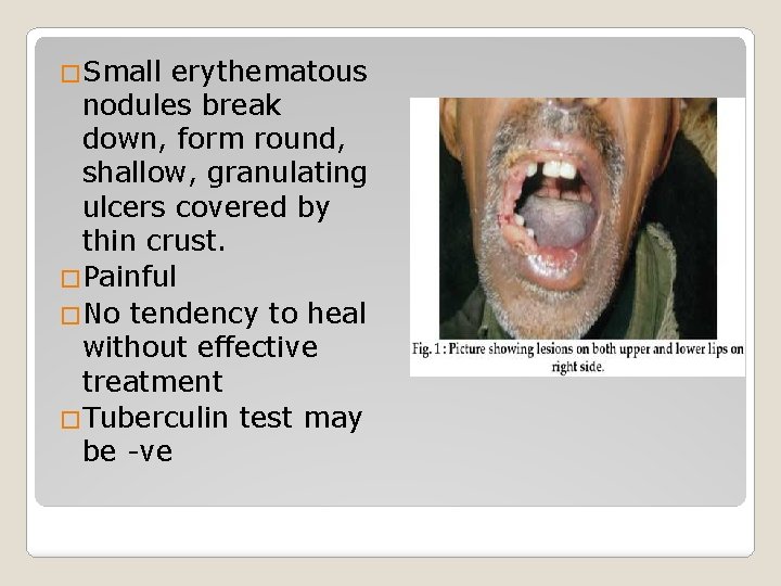 �Small erythematous nodules break down, form round, shallow, granulating ulcers covered by thin crust.