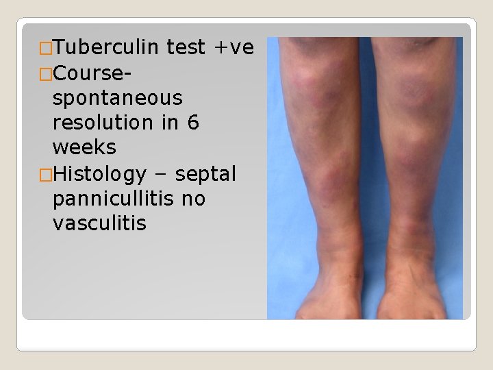 �Tuberculin �Course- test +ve spontaneous resolution in 6 weeks �Histology – septal pannicullitis no