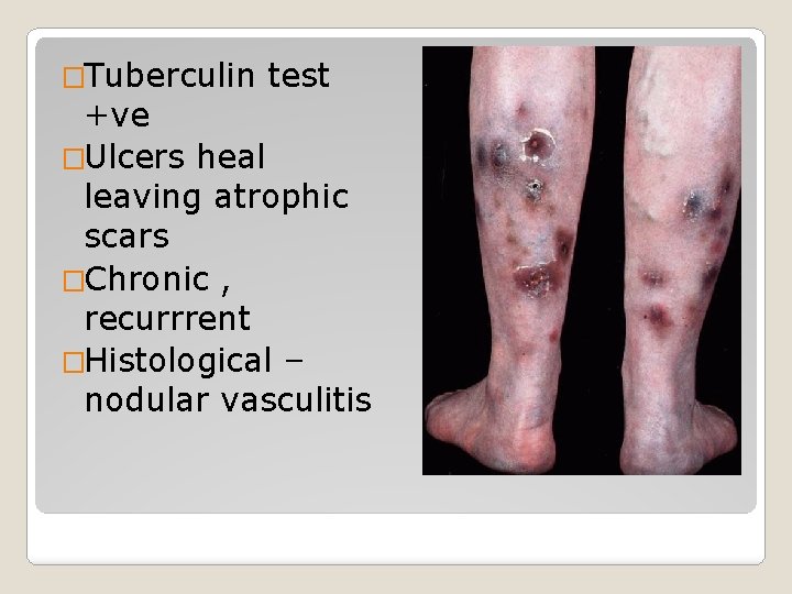 �Tuberculin test +ve �Ulcers heal leaving atrophic scars �Chronic , recurrrent �Histological – nodular