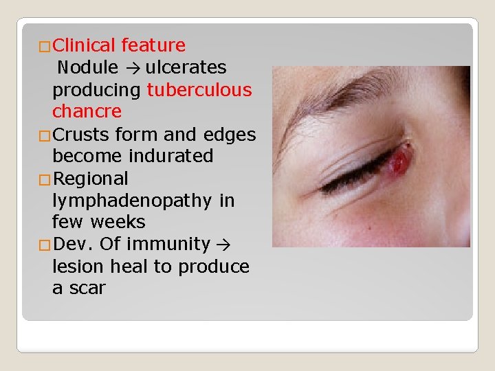 �Clinical feature Nodule → ulcerates producing tuberculous chancre �Crusts form and edges become indurated